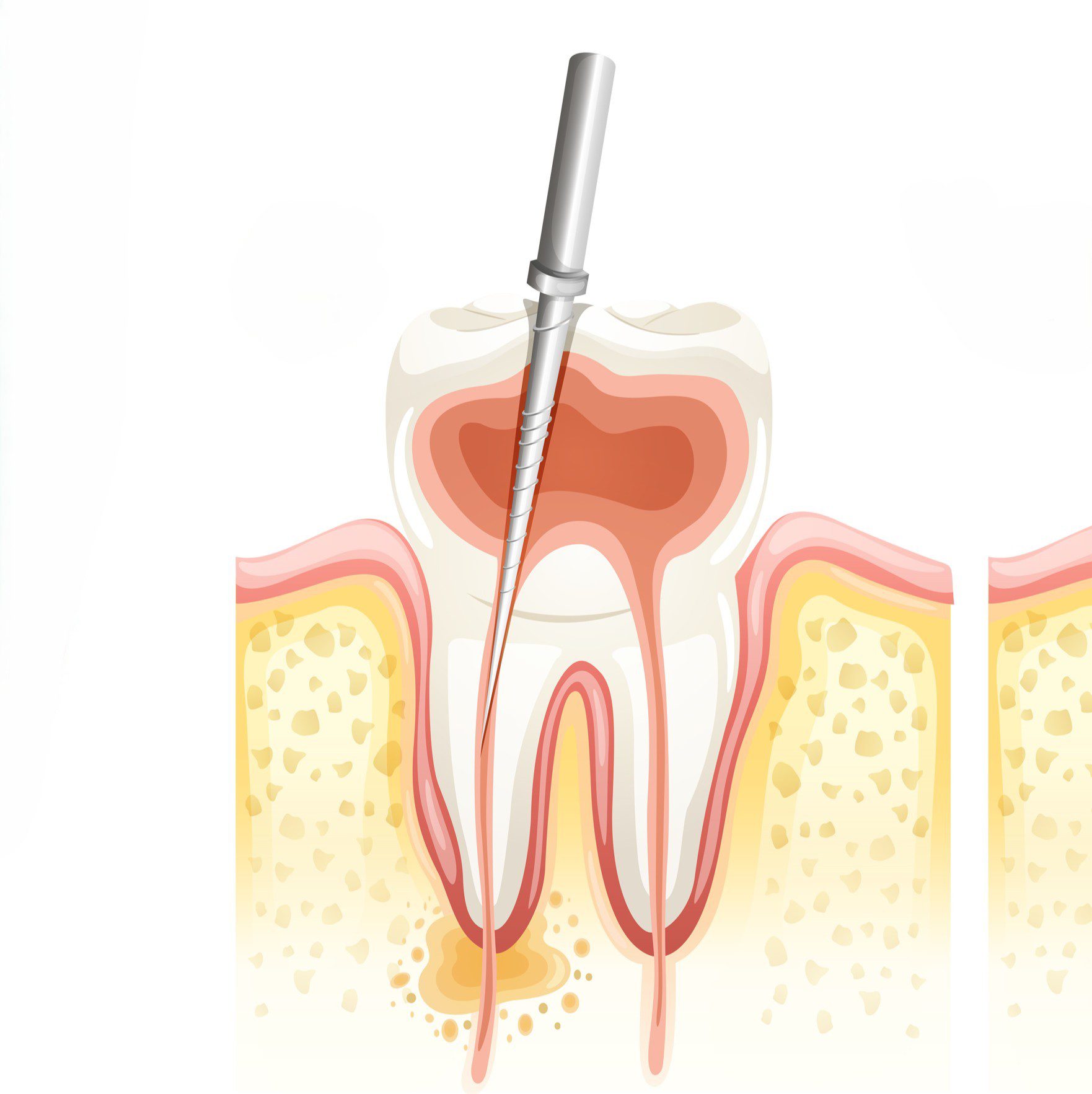 Dental Vector of Root Canal Treatment Root canal treatment Phuket Patong Dentist