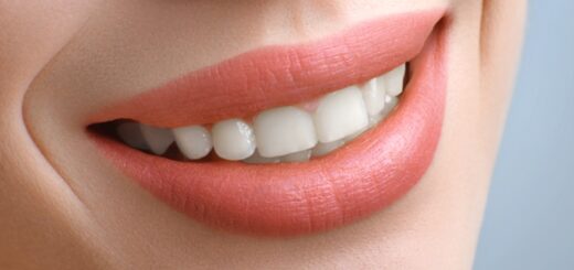 Dentist Phuket Patong. Crowns, Bridges, and Veneers.