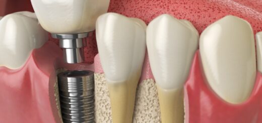 dentist Phuket Patong Veneer Dental Implants